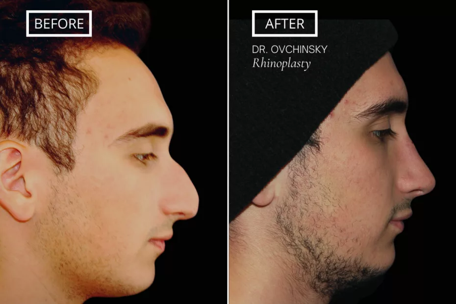 improve your breathing with rhinoplasty 5